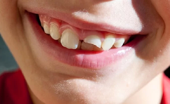 nằm mơ bị rụng răng