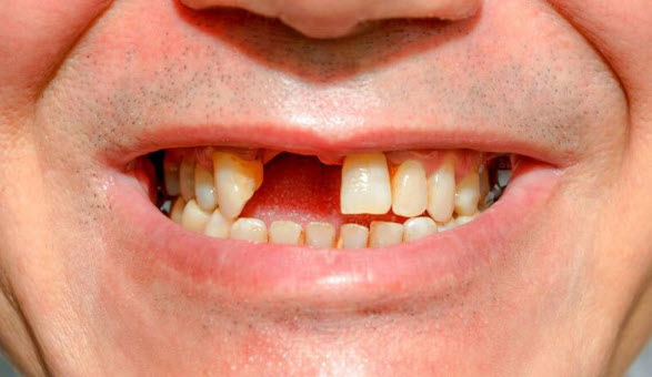 nằm mơ bị rụng răng