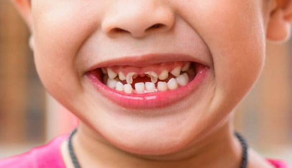 nằm mơ bị rụng răng