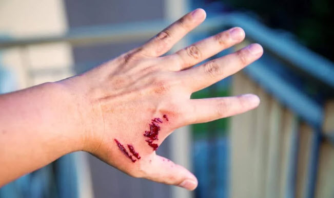 nằm mơ thấy chó cắn vào tay không chảy máu