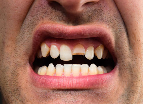 nằm mơ thấy gãy răng không chảy máu